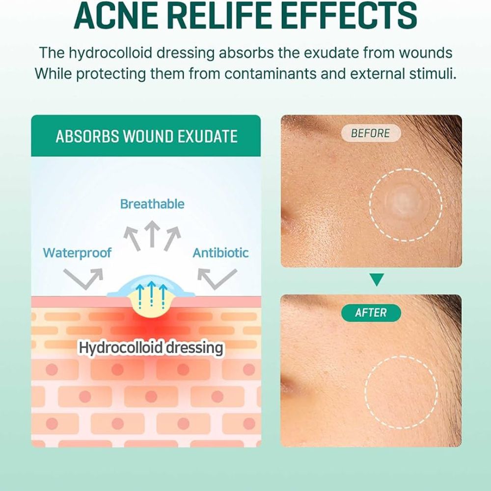 Some by Mi AHA-BHA-PHA 30 Days Miracle Clear Spot Patches Invisible